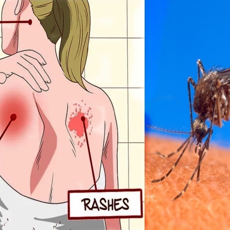 chikungunya virus symptoms and treatment